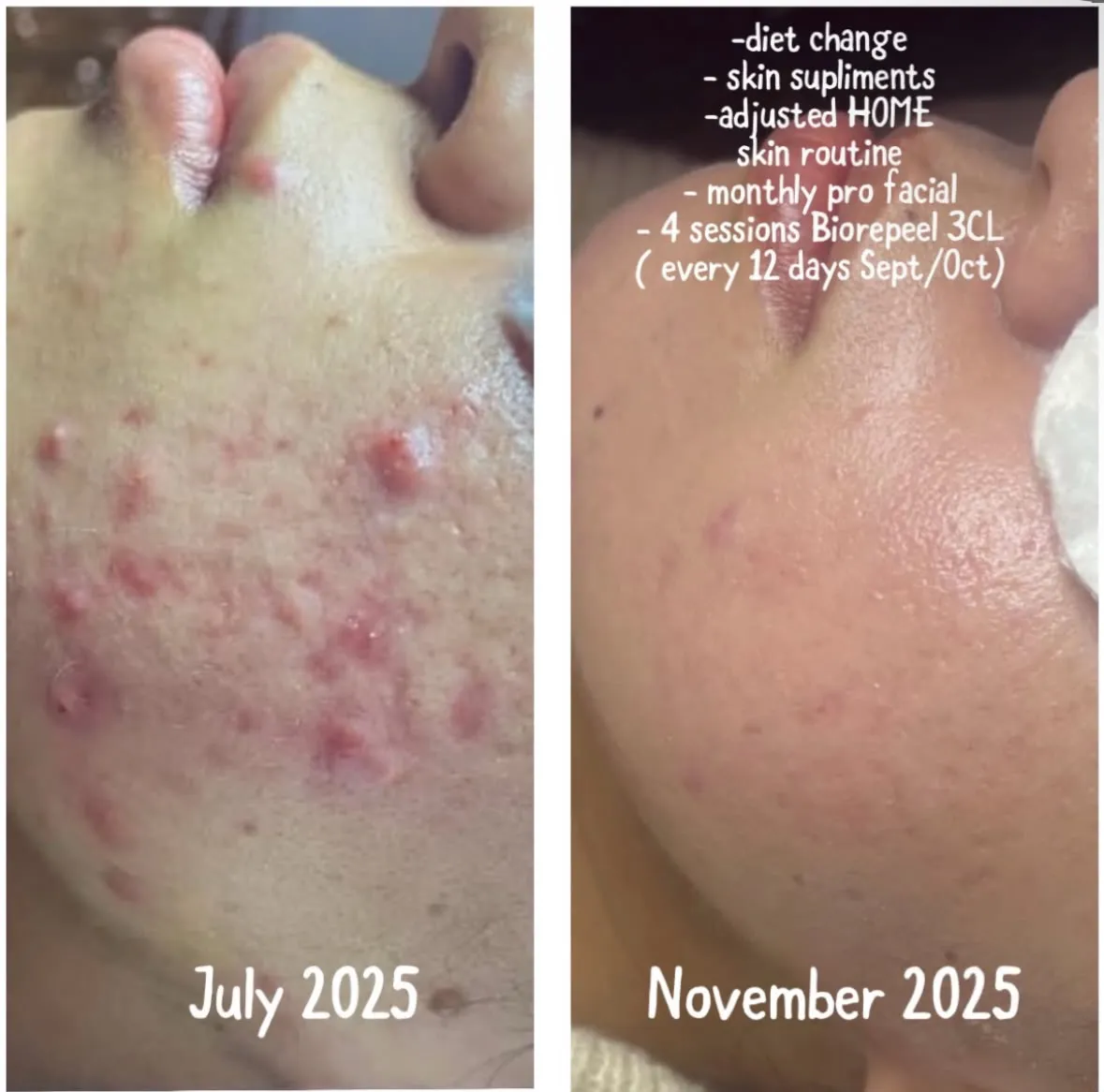 Two photographs of the same cheek, July 2025 on the left and November 2025 on the right, with Andreea’s notes on what was done