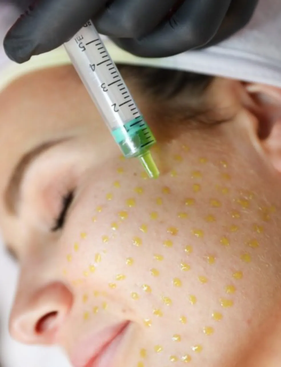 Drops of BioRePeel solution dotted over a client’s cheek, applied from a syringe by a gloved hand