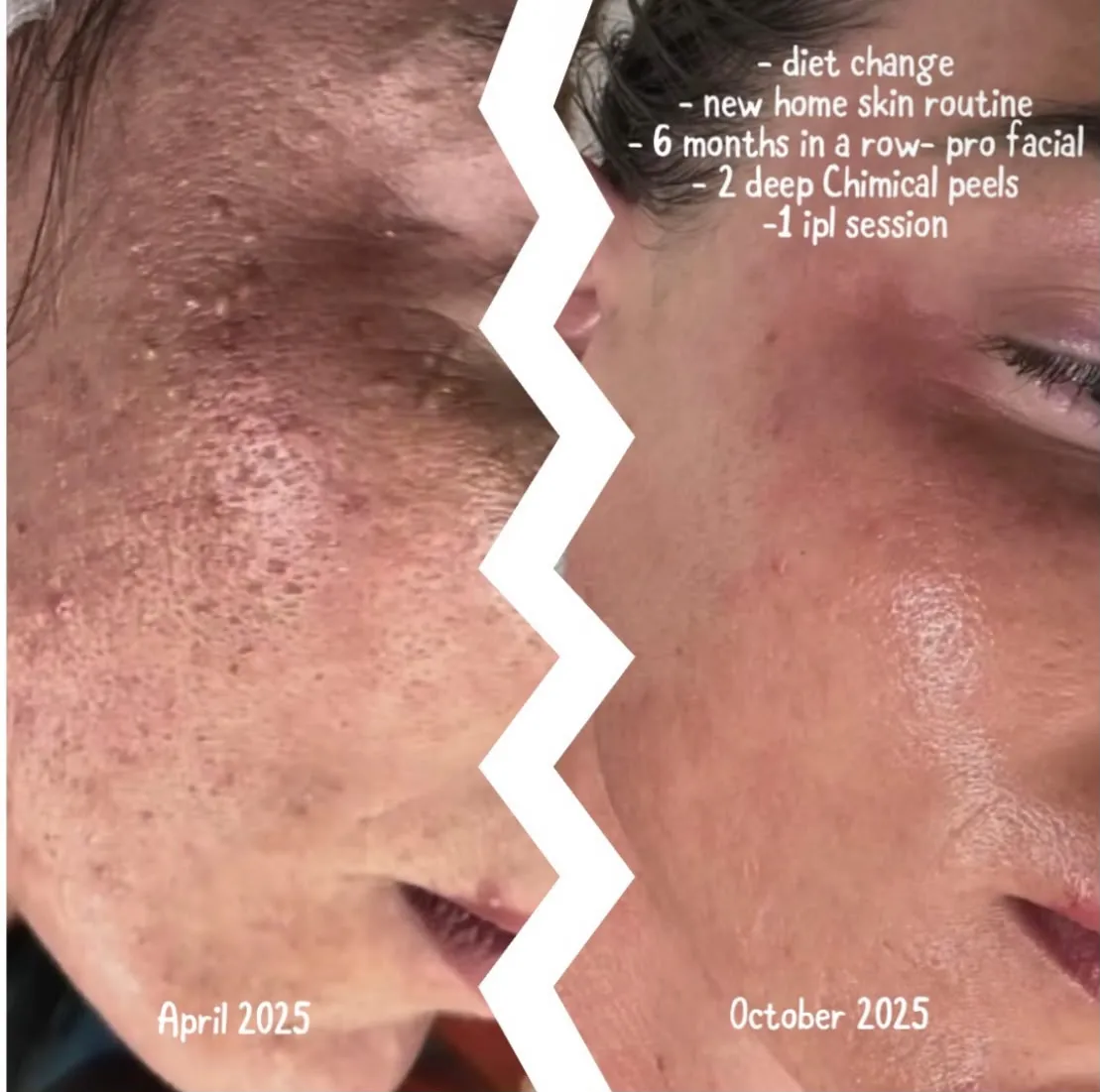 Two photographs of the same cheek, April 2025 on the left and October 2025 on the right, with Andreea’s notes on what was done