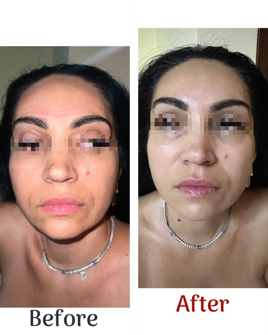 Two photographs of the same face and neck, side by side, labelled Before and After, with the eyes pixelated for privacy