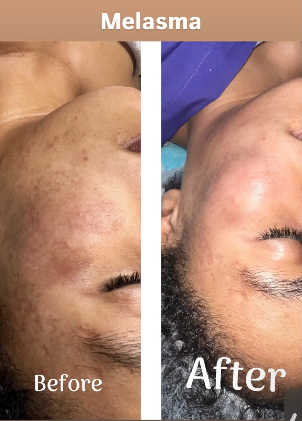 Two photographs of the same cheek with melasma, side by side, labelled Before and After