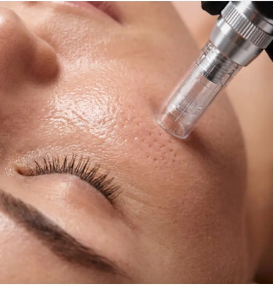 A microneedling pen moving over a client’s cheek, her eyes closed